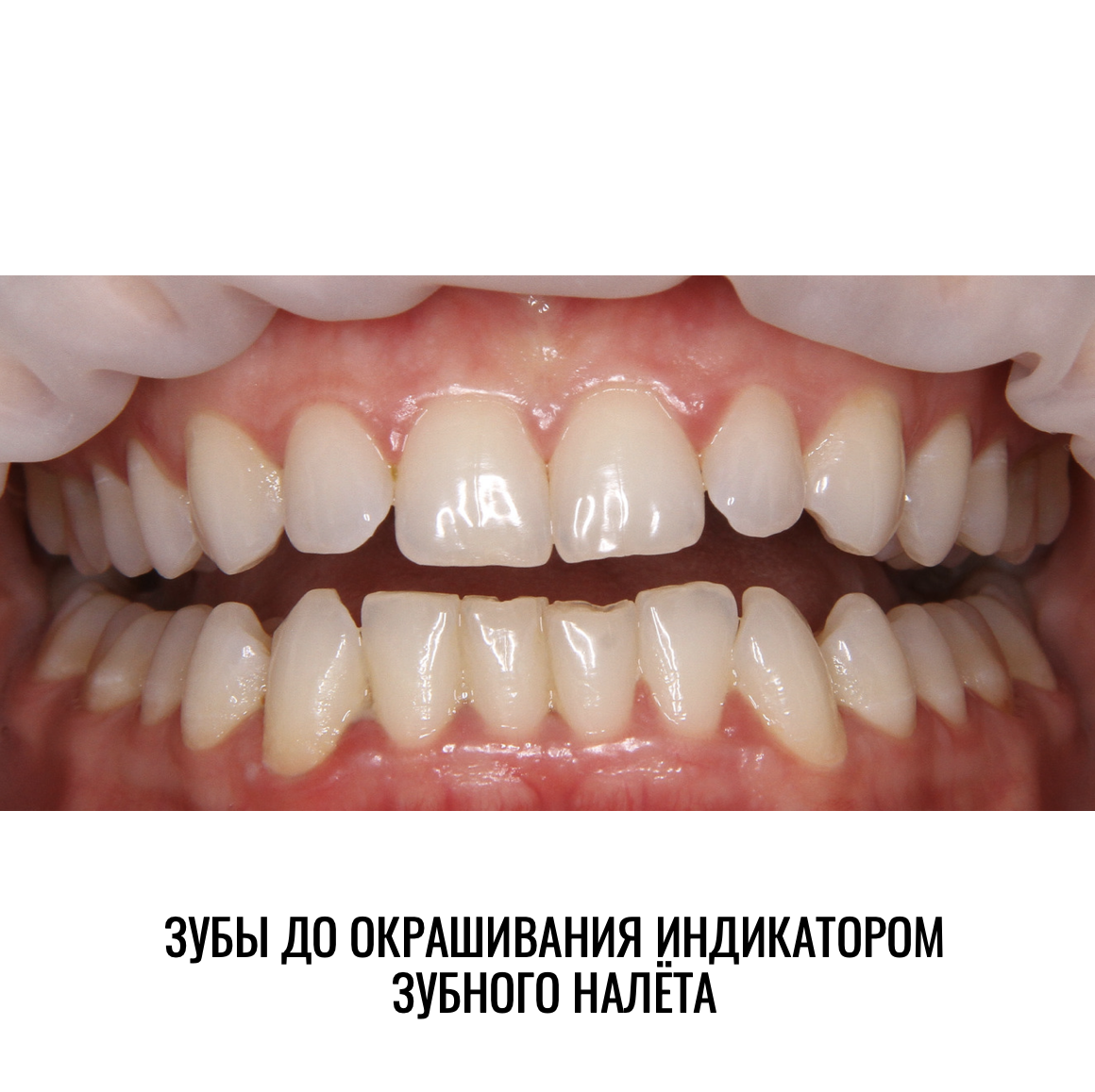 Попробуйте определить, где еще есть налёт, помимо нижних зубов?