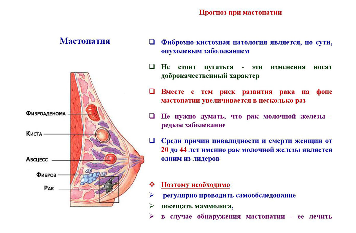 Мастопатия ~ Фиброзно-кистозная болезнь молочной железы