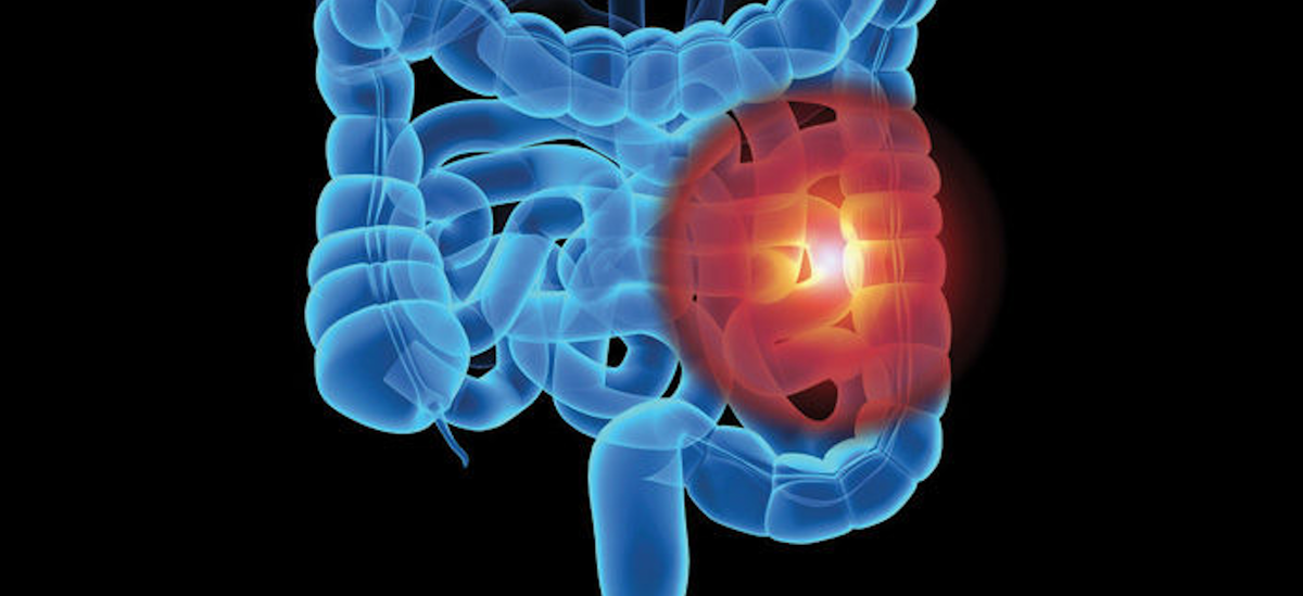 Кальпротектин. Повышен фекальный кальпротектин? Без паники! | Клиника ...