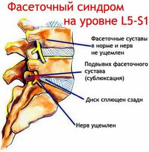 Фасеточная блокада. Фасеточные межпозвонковые суставы. Фасеточные суставы поясничного отдела. Фасеточный синдром шейного отдела. Блокада фасеточного сустава l5-s1.