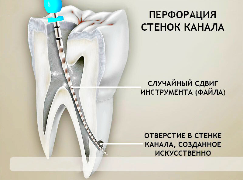 Болит зуб под пломбой, что делать?