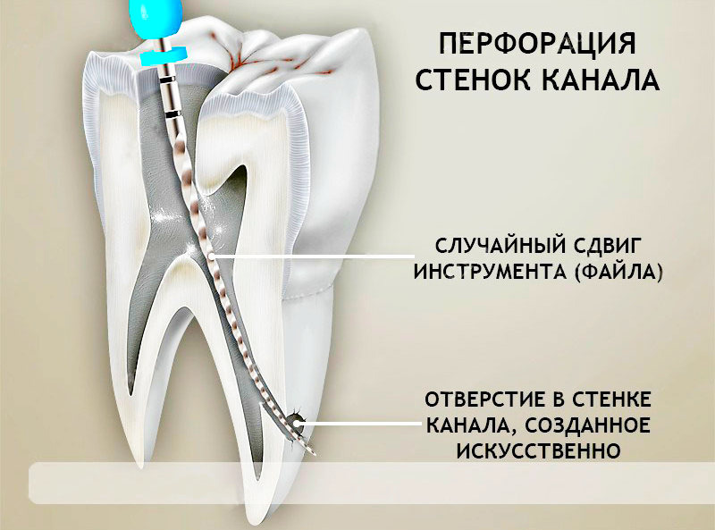 Что делать если заболел зуб под коронкой?