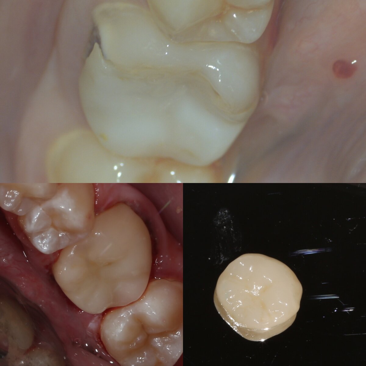 Коронка на передние зубы | Виды, преимущества, недостатки | Клиника семейной стоматологии Дока-Дент