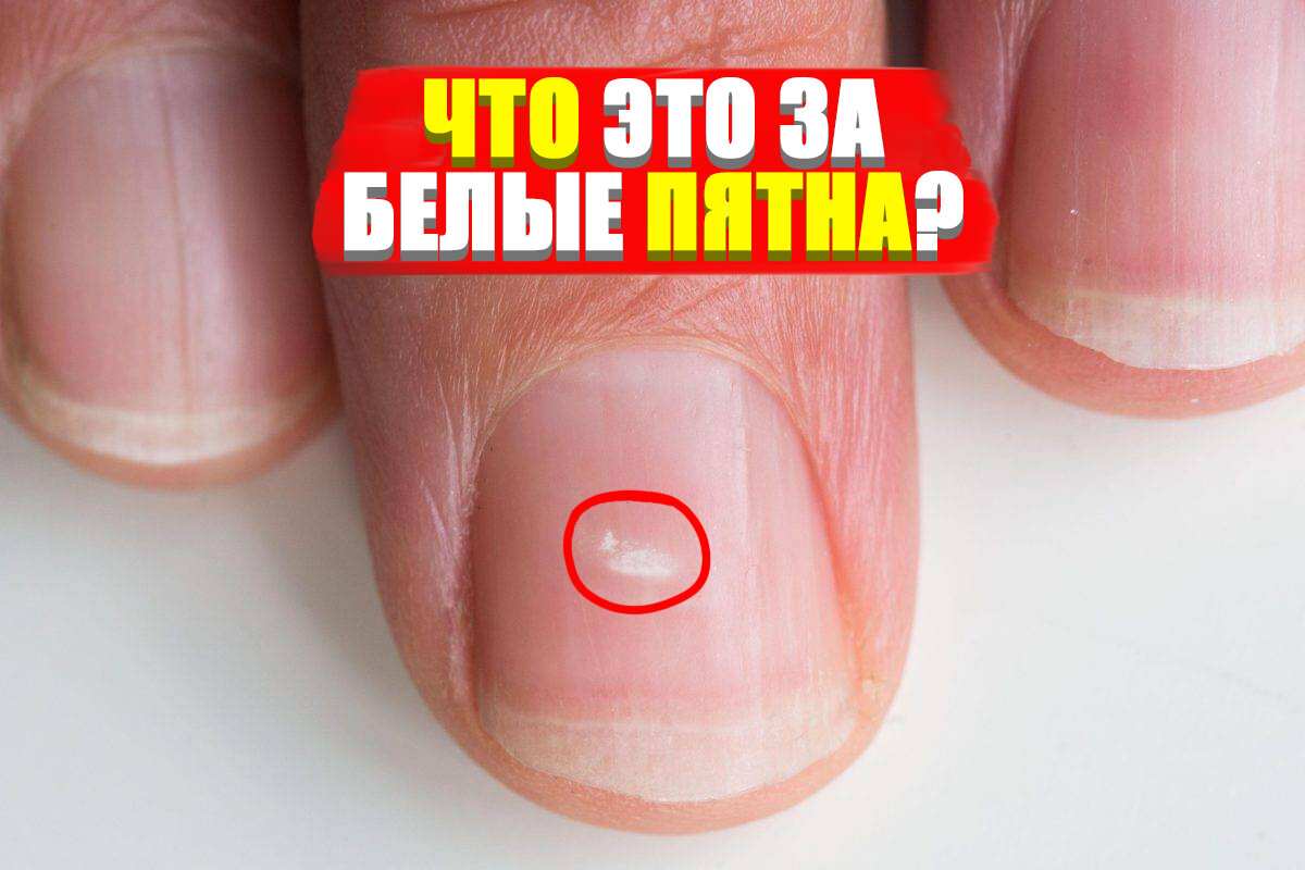 Белые пятна на ногтях 