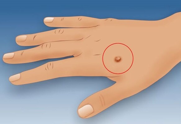 как избавиться от бородавок в домашних условиях