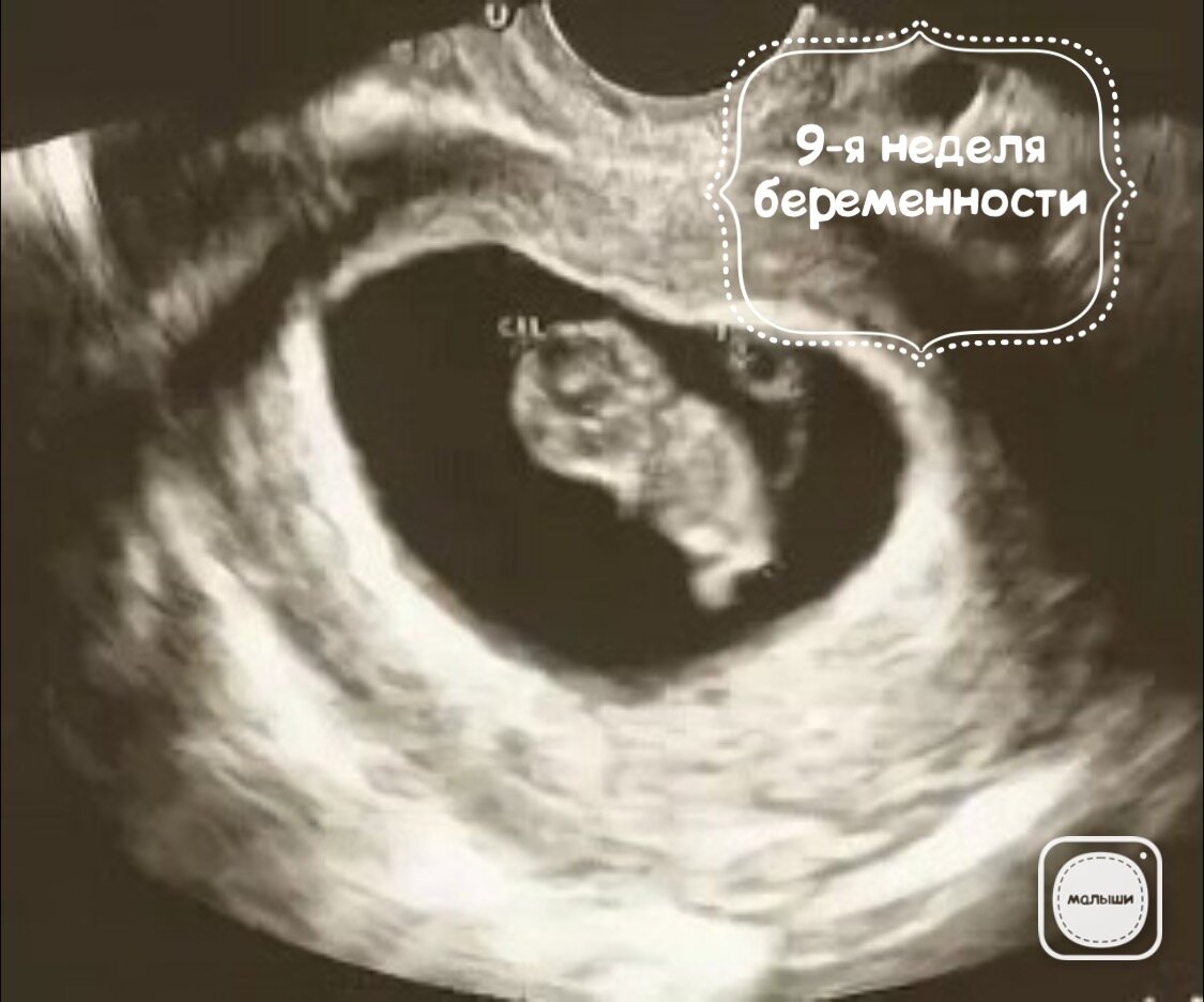 осмотр на кресле в 9 недель