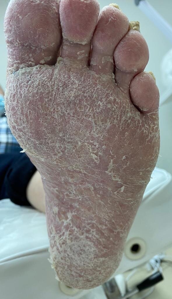 При диабете 1ой степени.