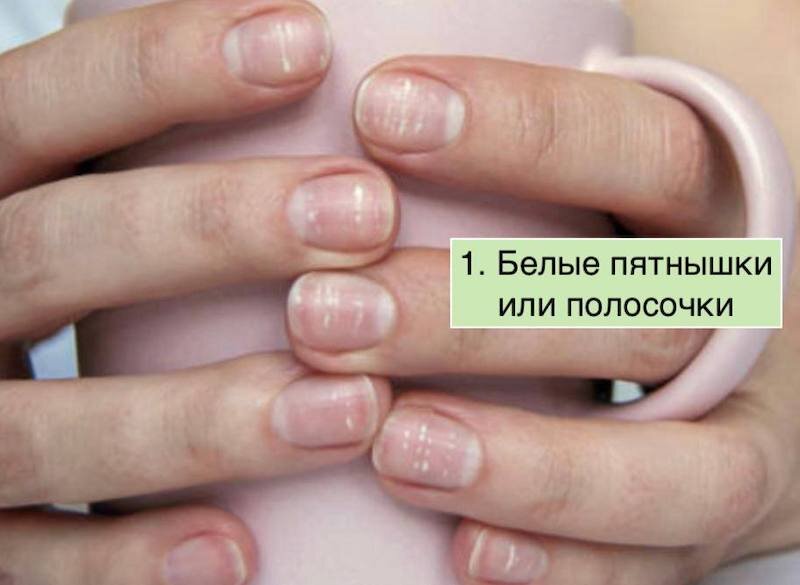 Почему ногти стали ребристыми на руках