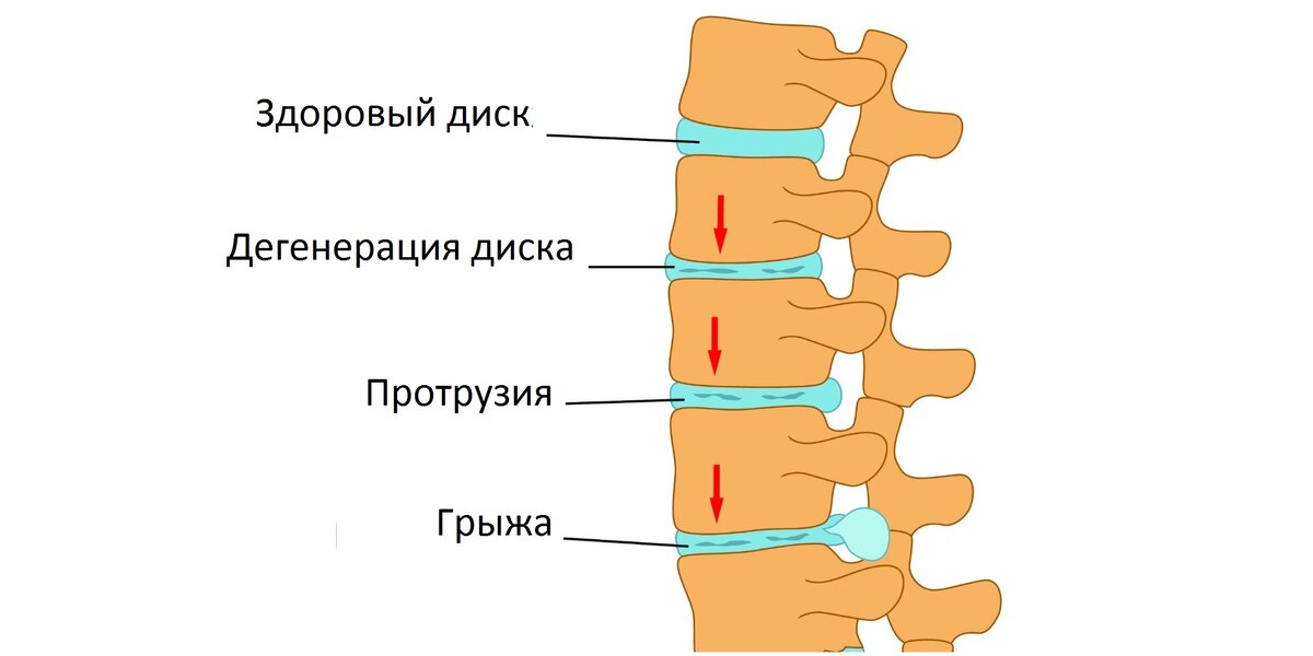 Как убрать грыжу на матрасе