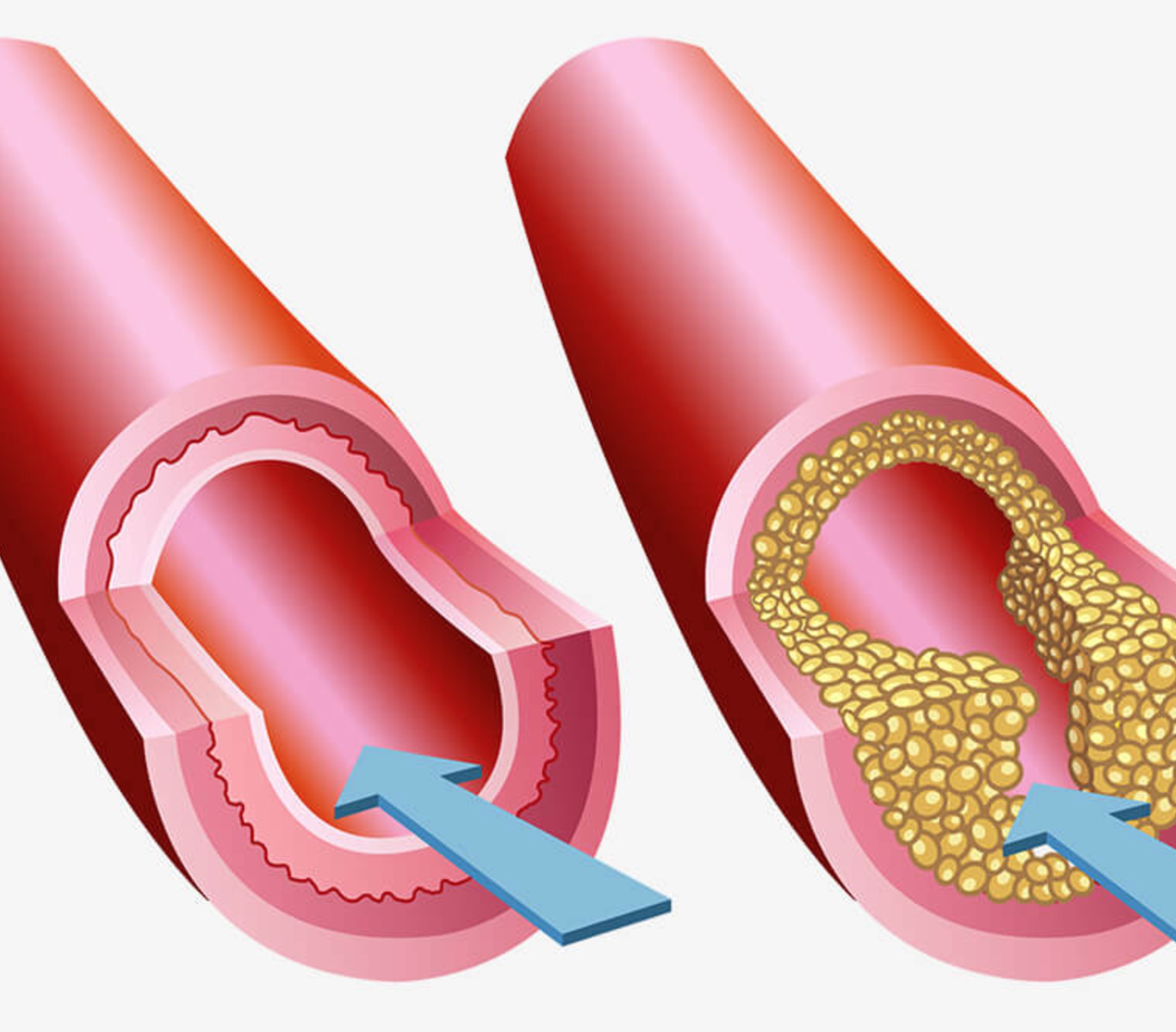 Толстая стенка сосуда. Холестериновые бляшки в сосудах. Здоровые кровеносные сосуды. Закупоривание артерий.