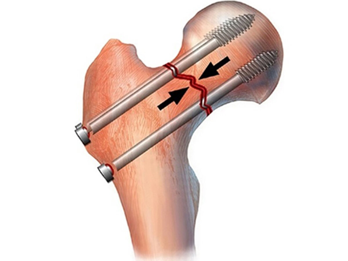 Как лечить трещину кости. Остеосинтез перелома бедренной кости. Остеосинтез перелома шейки бедра канюлированными винтами. Перелом шейки бедра остеосинтез. Остеосинтез шейки бедренной кости винтами.
