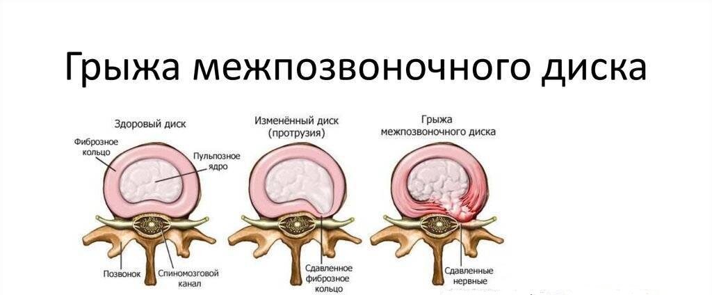 Удаление грыжи шейного отдела позвоночника отзывы