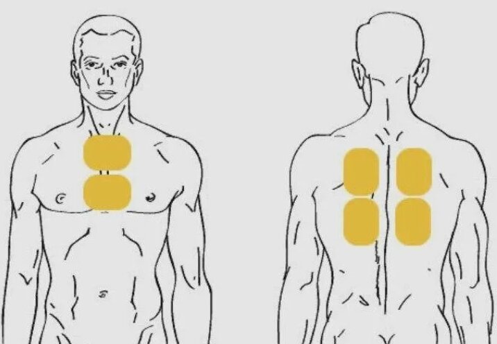 Как правильно поставить горчичники. Горчичники и бронхит. Места наложения горчичников при кашле. Как правильно поставить горчичники. Куда ставить горчичники на спине.