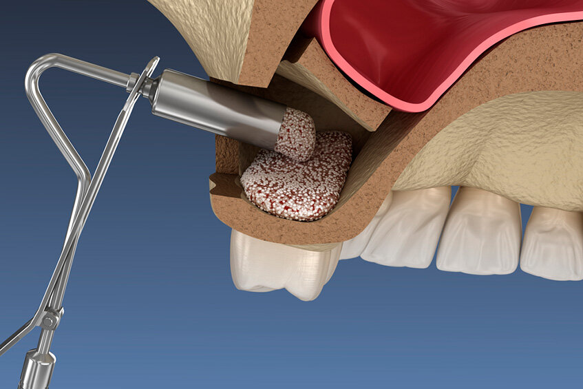 Когда необходимо провести синус-лифтинг?