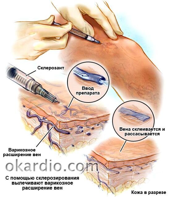 Процедура склеротерапии. 