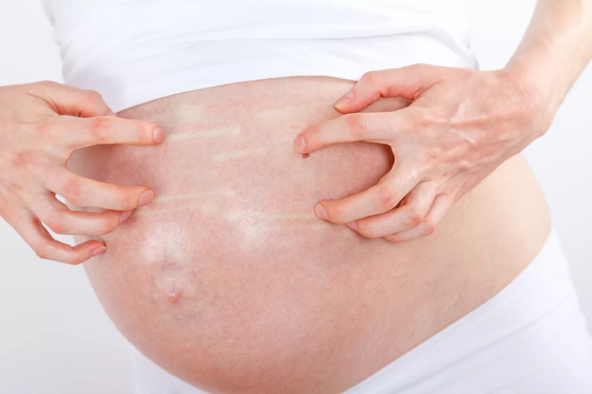 Зуд после беременности. Дерматит на животе у беременных. Дерматит на животе при беременности.