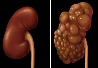 Внешний вид здоровой и поликистозной почки
