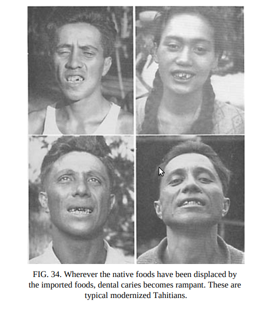 Натуральная пища была заменена импортной, обнаружен обширный кариес. На рис. типичный модернизованый Таитянины.