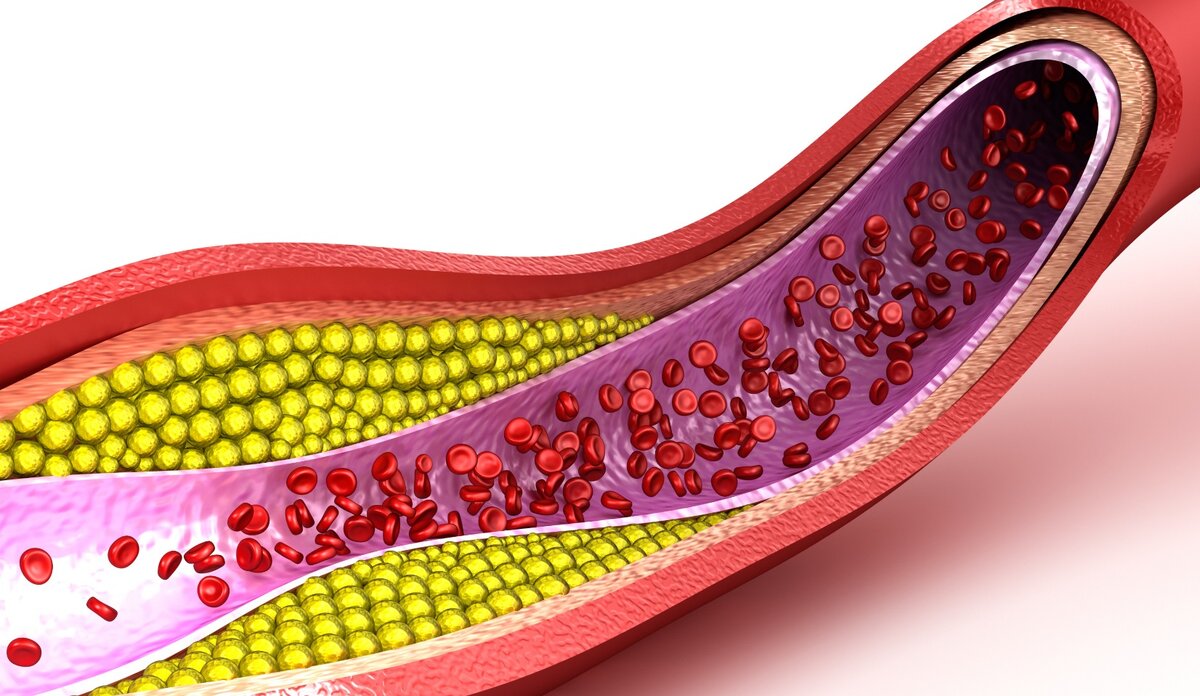 Внутренняя поверхность сосудов. Холестерин. Холестериновые бляшки в сосудах. Атеросклеротическая бляшка. Холестерин картинки.