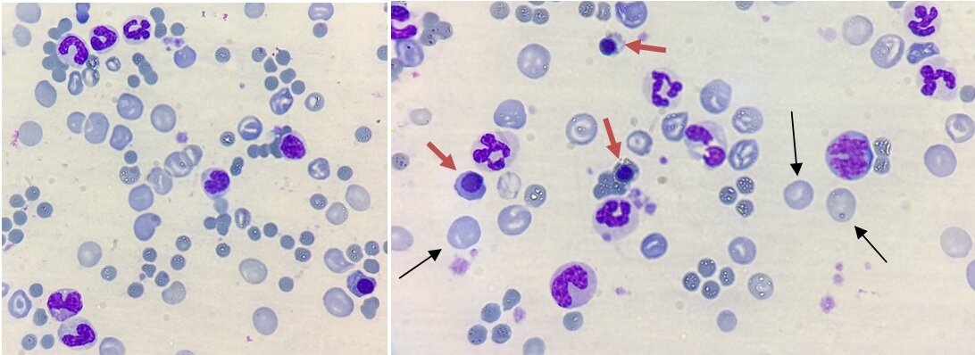 Фото 1. Препарат крови кошки. Иммерсионная микроскопия объектив ×100.  Анизоцитоз с преобладанием макроцитов. Полихромазия. На 100 лейкоцитов 67 рубрицитов. 
Черными стрелками показаны макроциты, красными рубрициты. 
