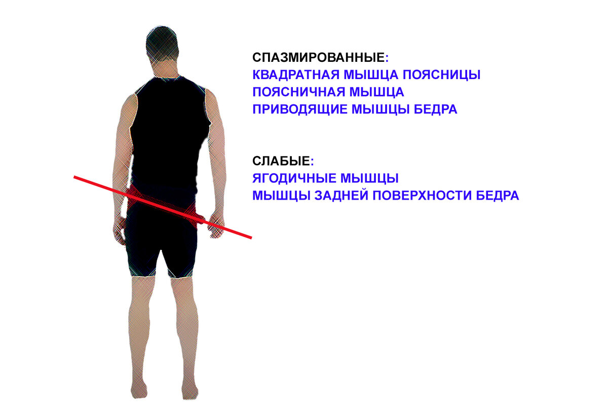 Асимметрия положения таза. Влияние на осанку.