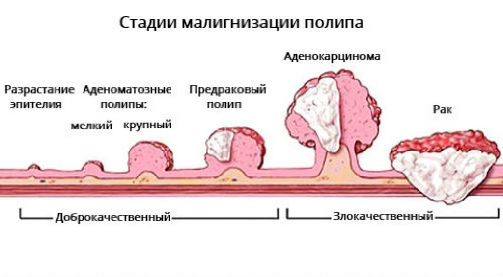 аденоматозный полип