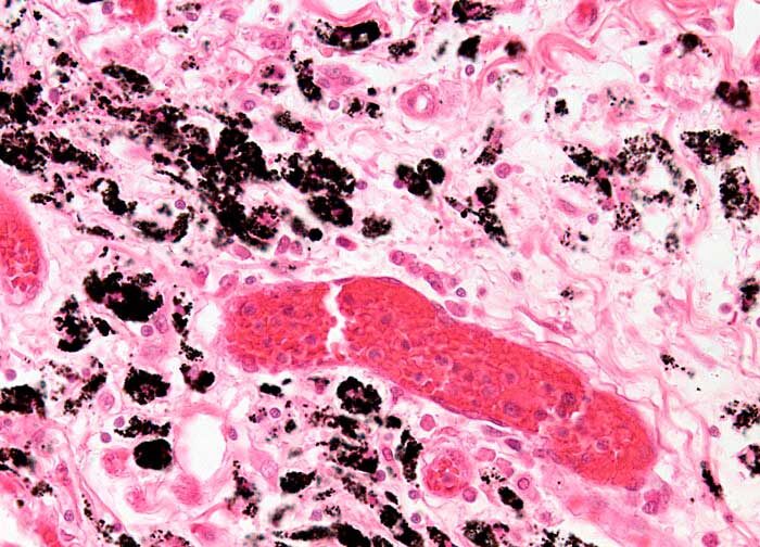 Клетки, зараженные токсоплазмозом