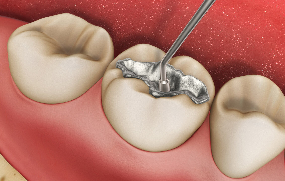 Иллюстрация амальгамной пломбы