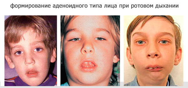 аденоидный тип лица