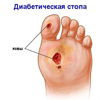 Наиболее распространённая локализация язв на подошве стопы