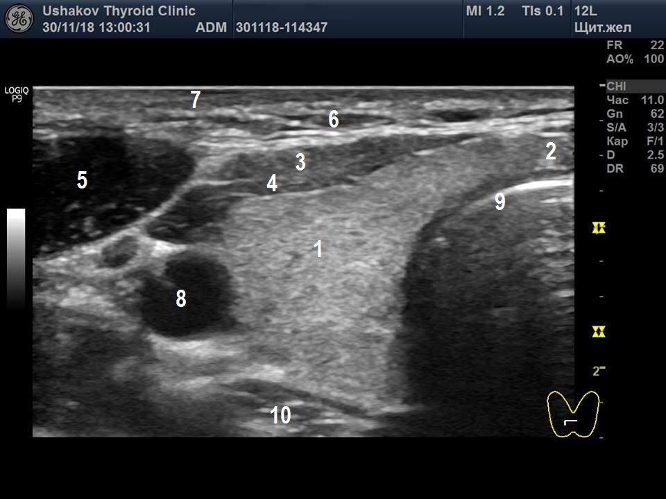Узел в правой доле щитовидной железы. Сегменты щитовидной железы на УЗИ. Щитовидные артерии на УЗИ. УЗИ ЩЖ норма. Доли щитовидной железы на УЗИ схема.