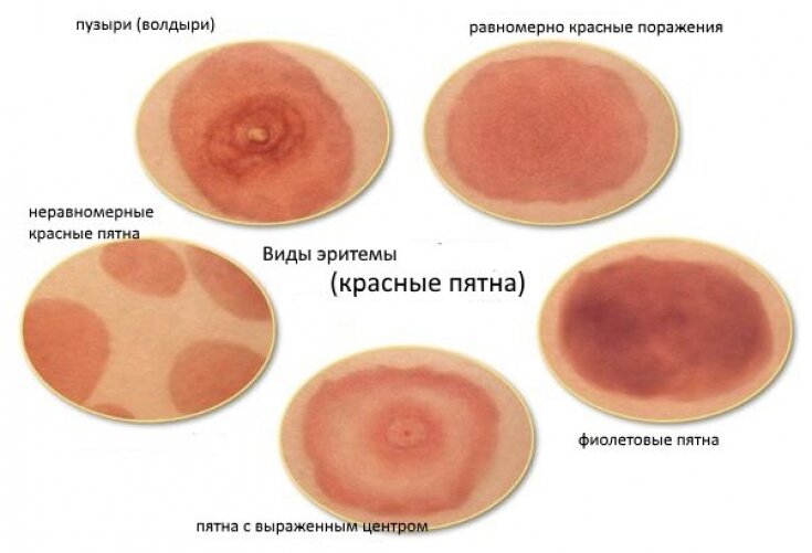 Бляшки и красные пятна на коже