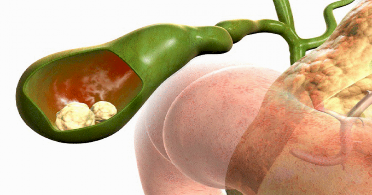 Образование камней в желчном. (источник яндекс картинки)