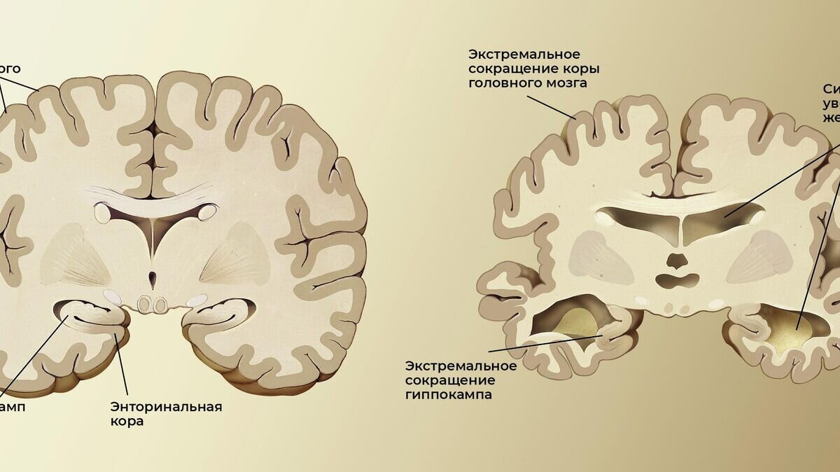    Мозг здорового пожилого человека (слева) и пациента с болезнью Альцгеймера (справа)CC0 / /