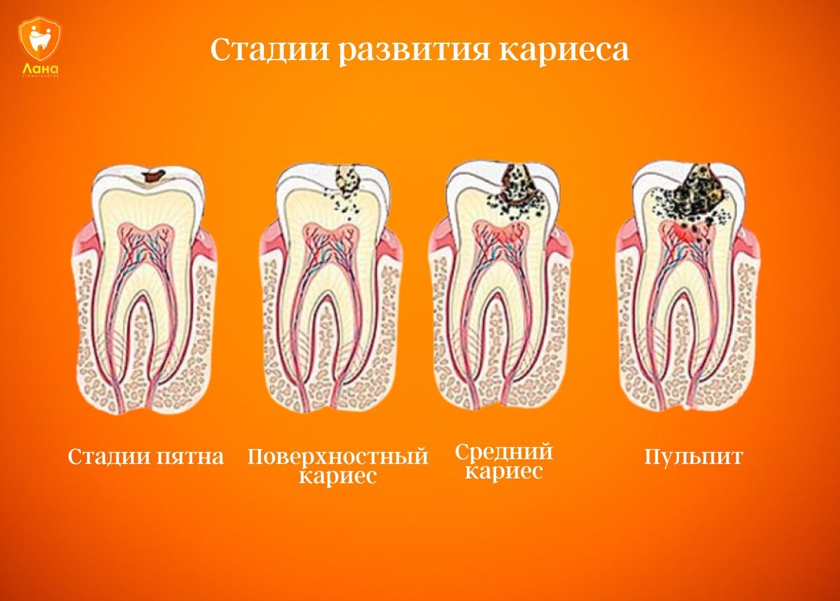 Кариес клиническая картина