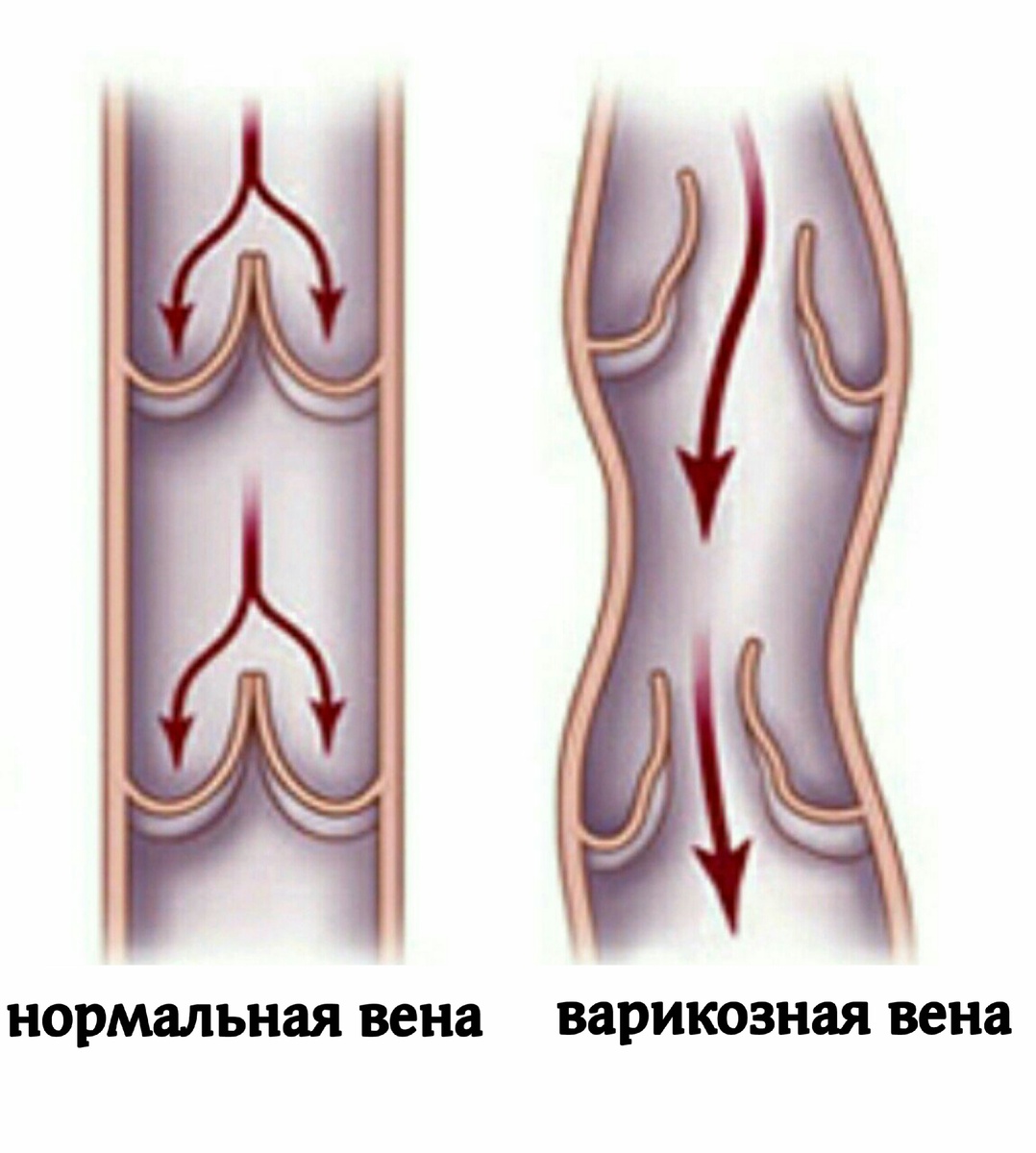 При низкой физической активности возникает увеличение венозного давления в ногах. Сосуды не выдерживают такое напряжение и начинают растягиваться, а их стенки  становятся тоньше. Из-за всего этого кровь идет в обратном направлении.