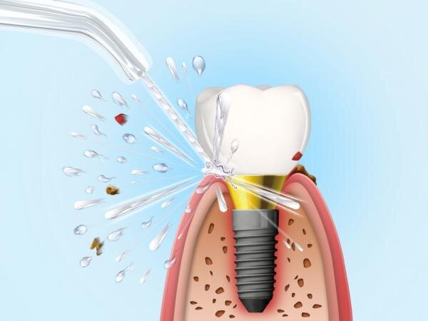 Гигиена импланта