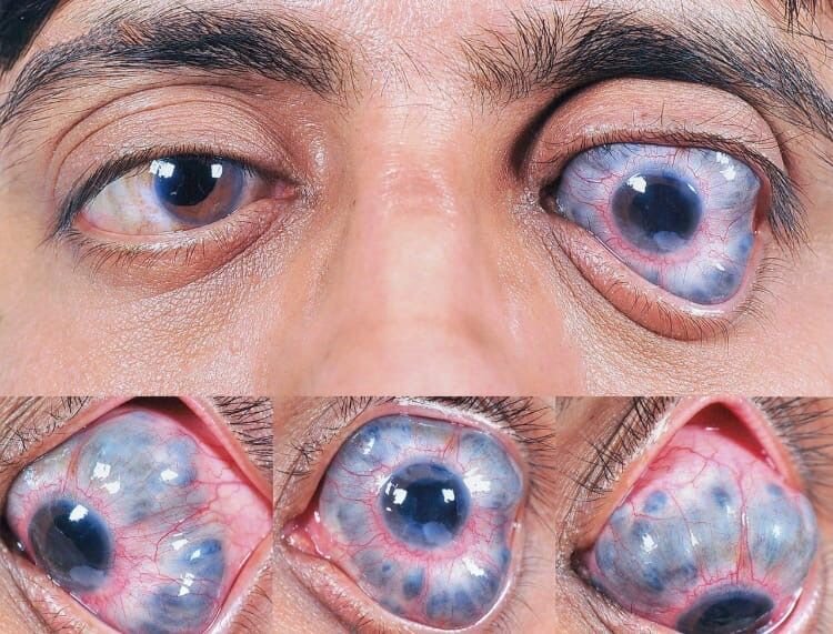 Болезнь глаза