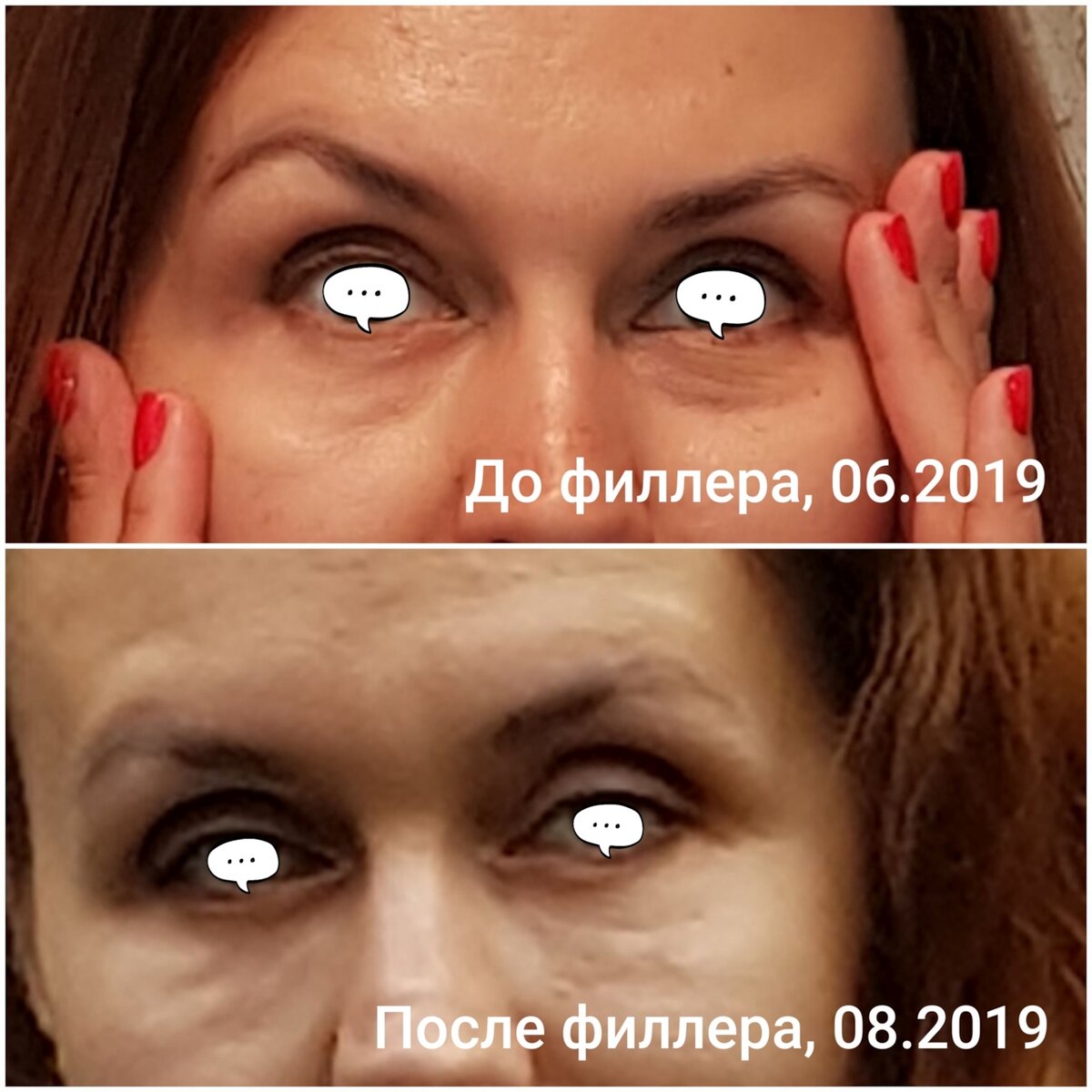 Да, с возрастом у меня под глазами стало плохо. Но филлер сделал ещё хуже (фотографии сделаны без вспышки - так заметны все изъяны).