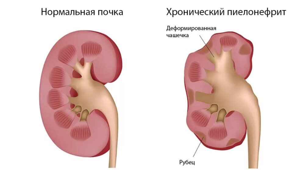 Воспаление почек лечение у женщин