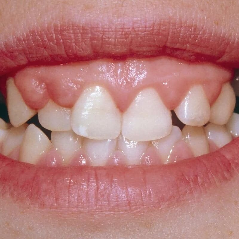 У воспалительных процессов есть много проявлений. Одно из них. Взята картинка из поиска Yandex