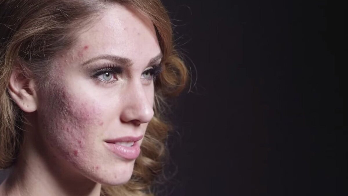 При серьезных проблемах с кожей лица румяна противопоказаны