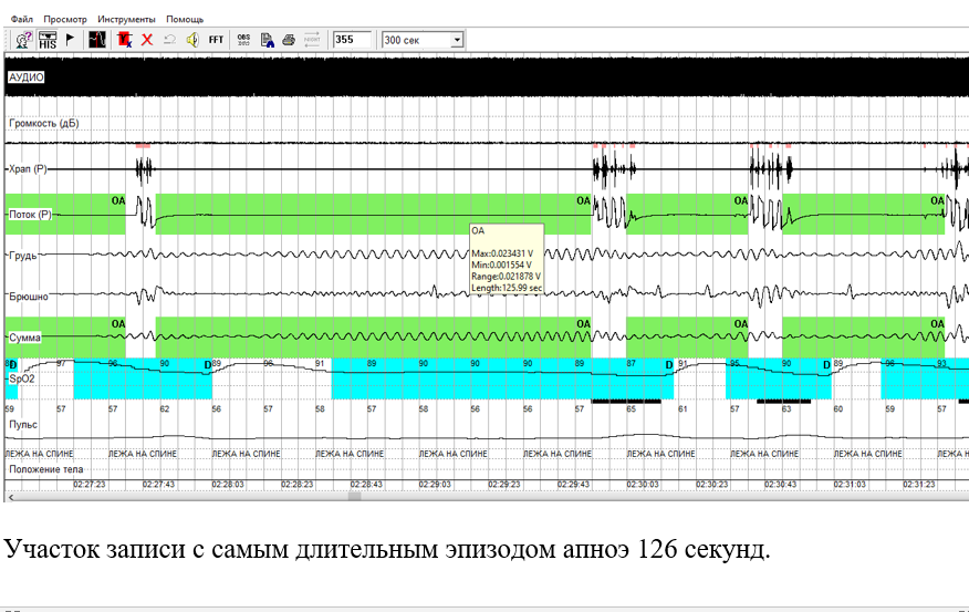 Фрагмент записи респираторного мониторинга: виден канал, где регистрируется храп (бОльшую часть времени храпа не было из-за остановок дыхания), ниже - воздушный поток на уровне рта и носа (прямая линия из-за отсутствия дыхания, перемежаемая синусоидой вдоха-выдоха), еще ниже - движения грудной клетки и живота - видно, как они двигаются в попытке вдохнуть, но безрезультатно, и самая нижняя кривая - это сатурация, которая падает всякий раз после остановки дыхания. Для удобства диагностическая программа окрашивает в зеленый и голубой важные события
