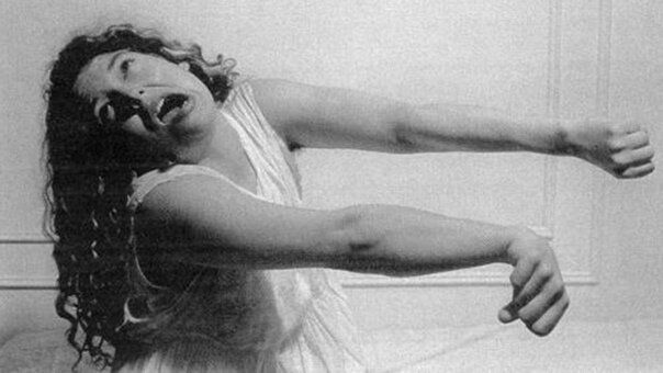 Конверсионный припадок у женщины