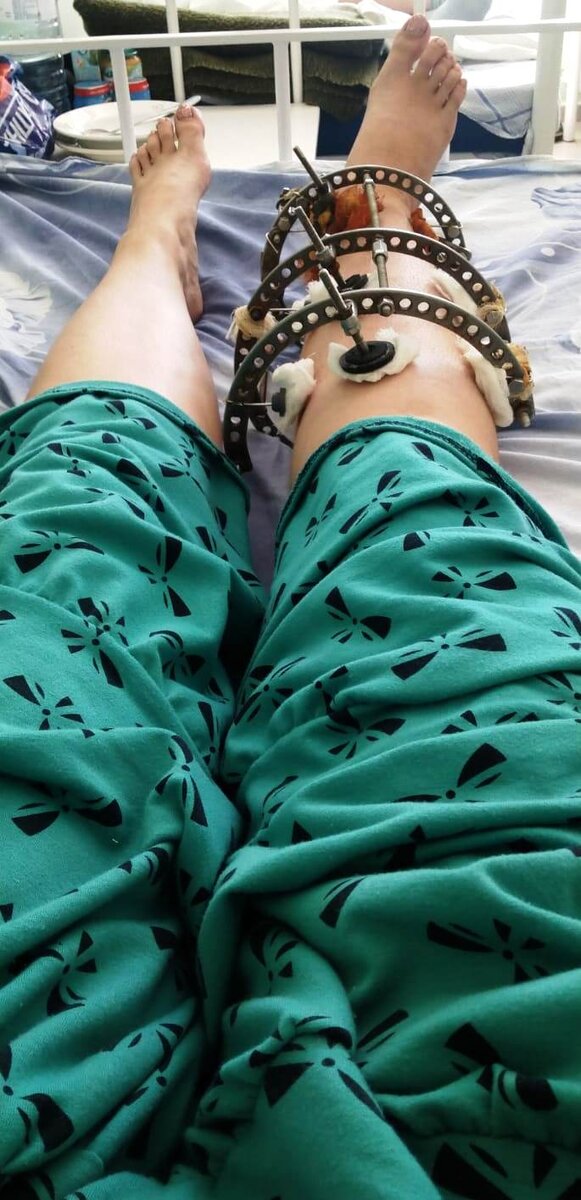 В день операции. Пришла в 12, в 14,00 аппарат уже сняли.