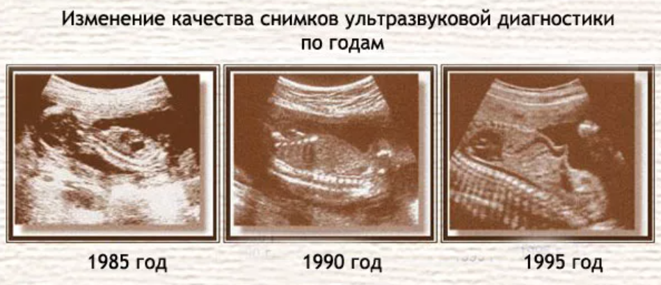 История создания УЗИ аппаратов | МСТ