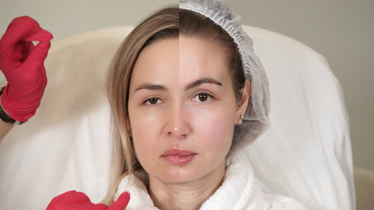 Справа результат сразу после процедуры