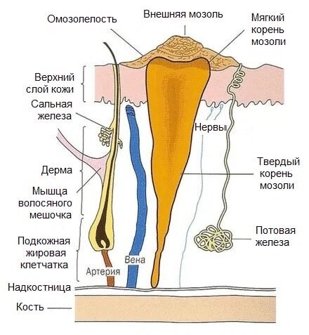 как выглядит сухая мозоль на стопе | Дзен