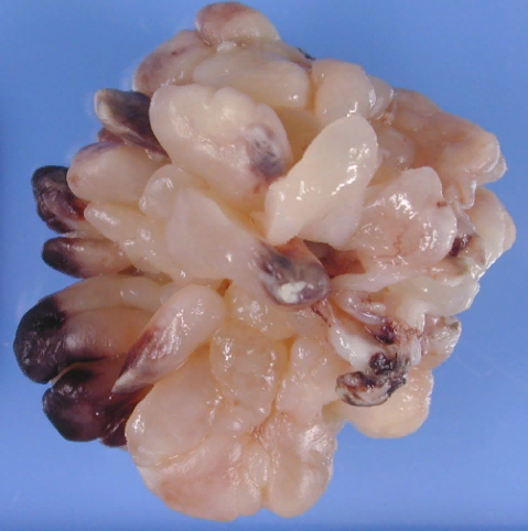 Рабдомиосаркома носоглотки