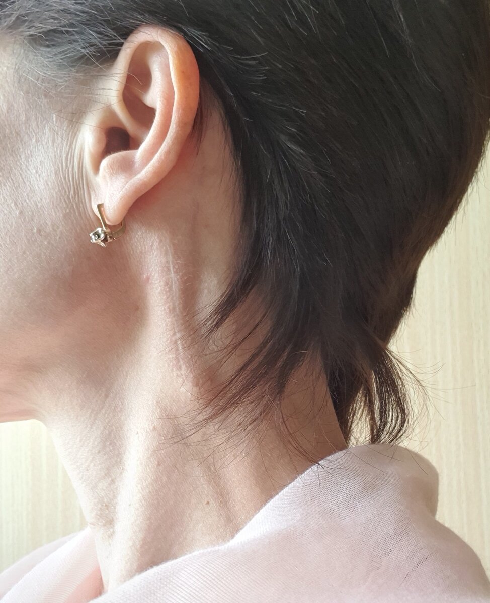 Шрам ниже уха-это то место где был тот самый воспалённый узел.